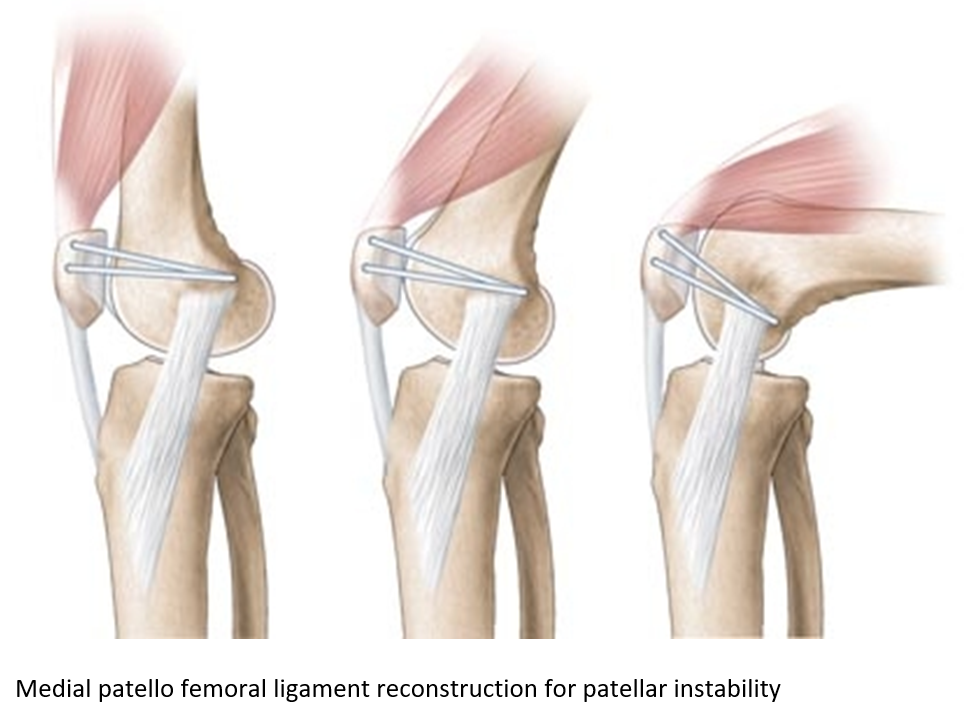 Multiple ligaments surgery Gallery 
